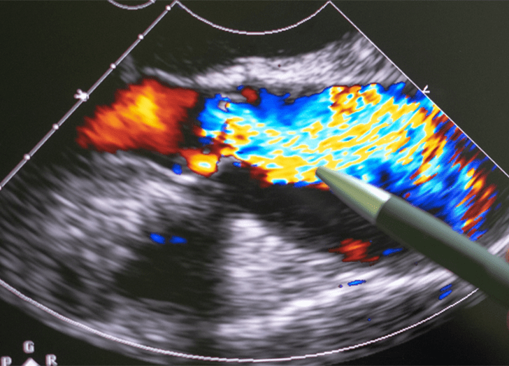 Echocardiography ultrasound.