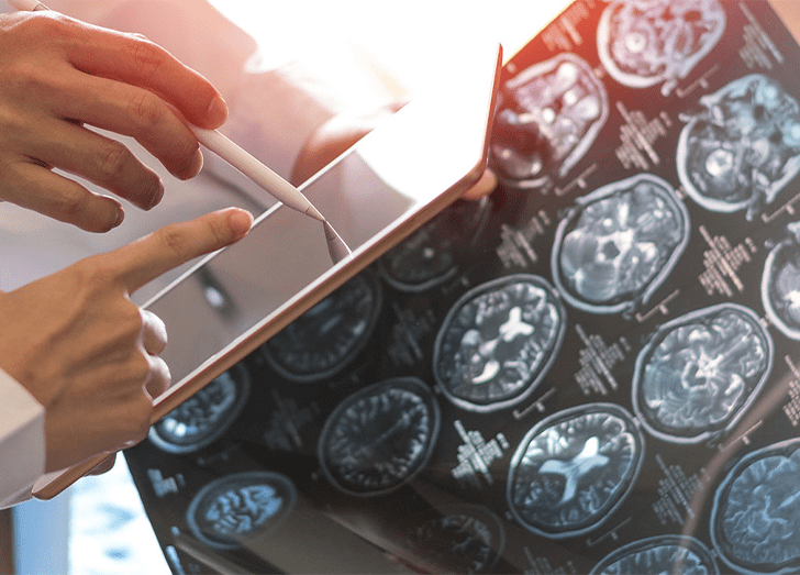 MRI digital x-ray of brain with team radiologist doctor oncology working together in clinic hospital.