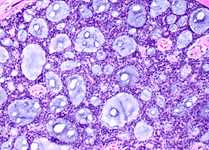 adenoid cystic carcinoma