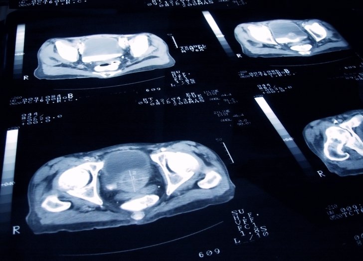 Prostate Disease