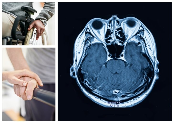 radiology image of brain with stroke, person getting PT, person in a wheelchair