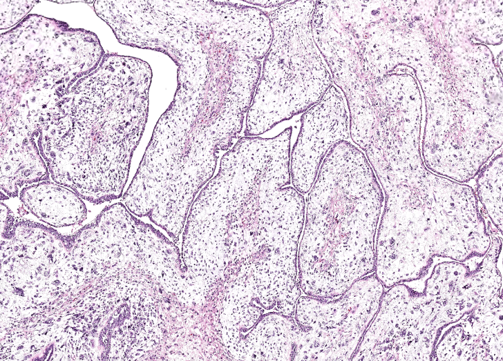 Image of adenosarcoma.